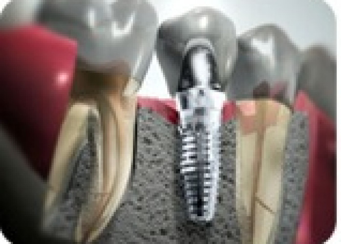 Implantes dentários em Curitiba