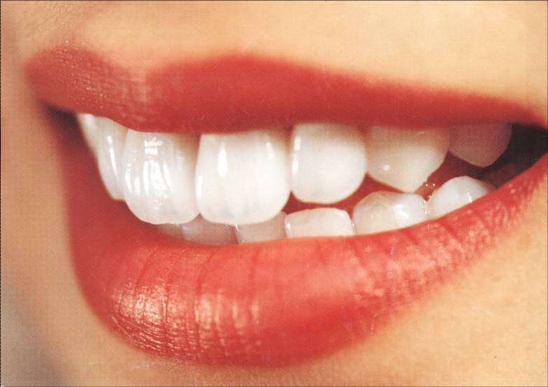 Implantes dentarios
