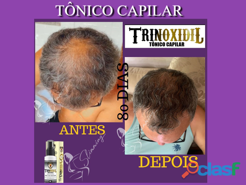 Alopecia Calvície tem Tratamento Tônico capilar